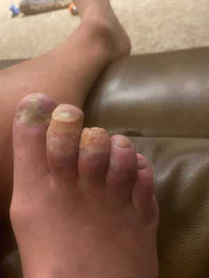 Chronic-Pain-Columbia-MO-Foot-Injury-After